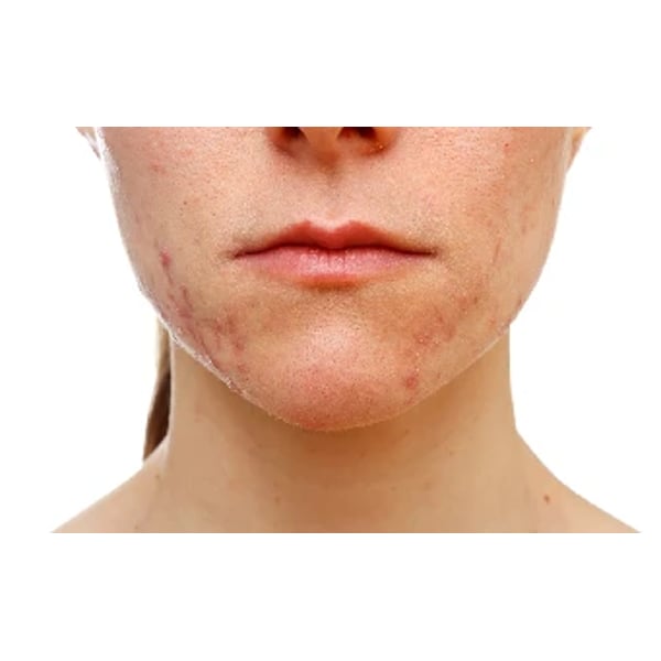Acne na mulher adulta