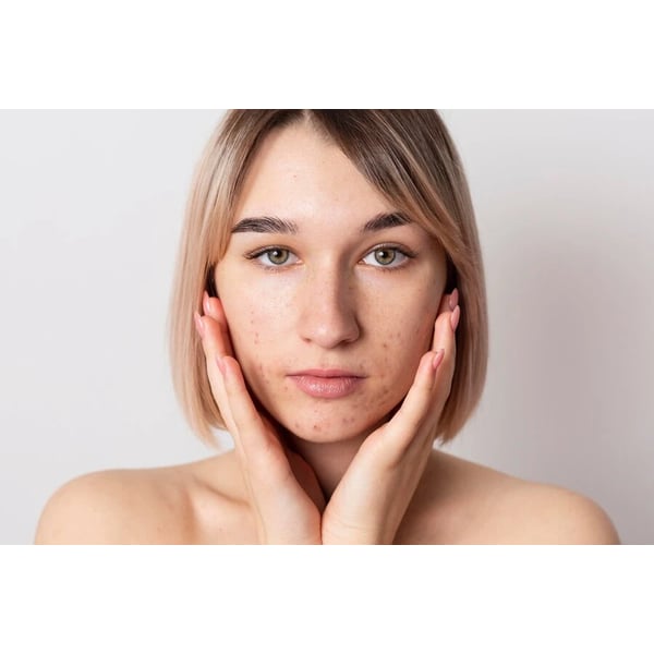 Acne versus Adolescência