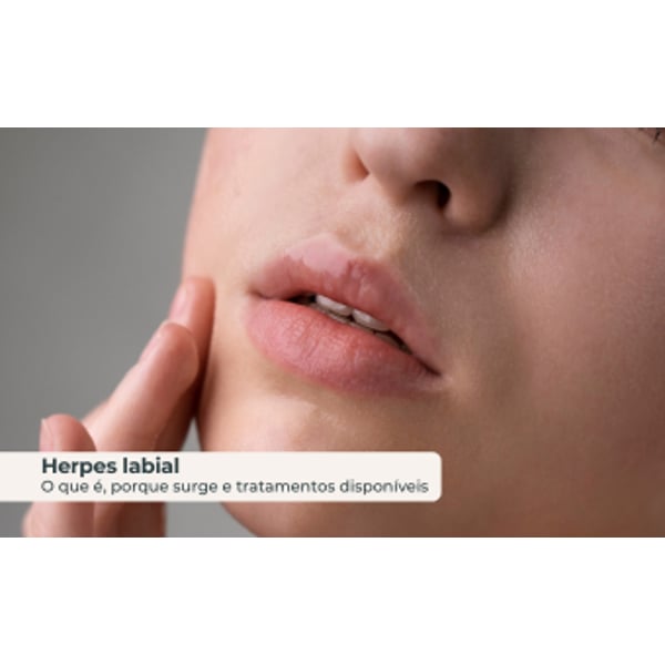 Herpes Labial: o que é, porque surge, e tratamentos disponíveis