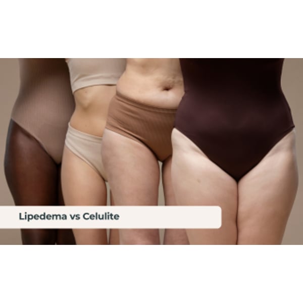 Lipedema  vs celulite: conhece a diferença?